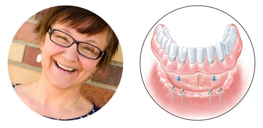 Kayla Dentures Boise ID 83727